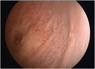 Consider the Risk of Vesicouterine Fistula in the Event of Intermittent Fluid Vaginal Discharge after a Cesarean Section